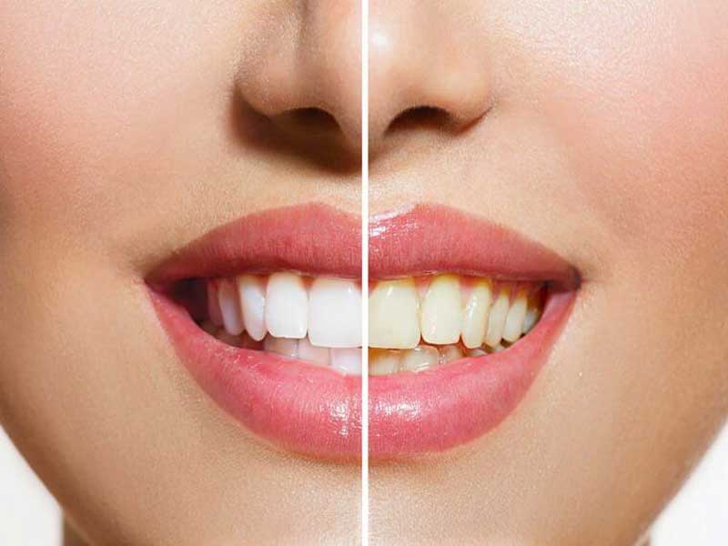 estetica-dentara-vef-dent-