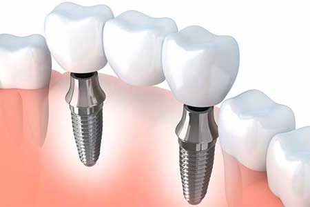 implantologie-vef-dent--