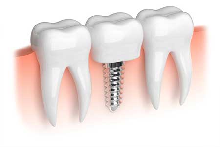 implantologie-vef-dent---