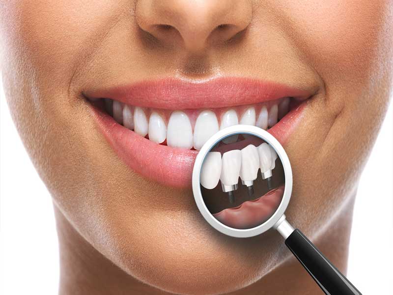 implantologie-vef-dent