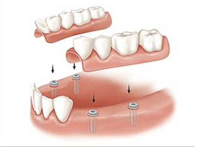 protetica-dentara-vef-dent-