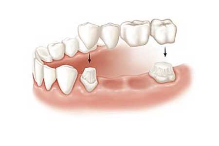 protetica-dentara--vef-dent-